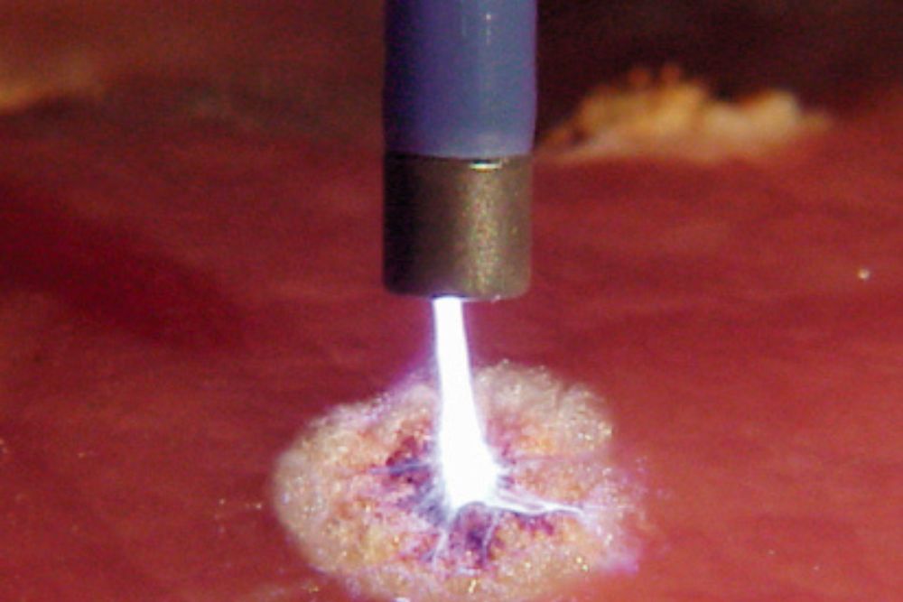 Coagulación con Argón Plasma con el Dr. José León Chirinos Revilla