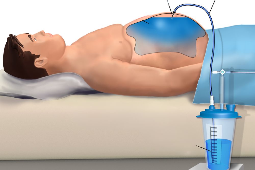 Paracentesis con el Dr. José León Chirinos Revilla